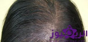 الصلع الوراثي من اهم الاسباب المؤدية لتساقط الشعر